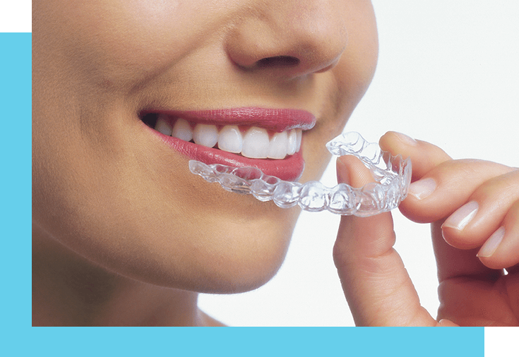 The Most Commonly Asked Questions About Invisalign