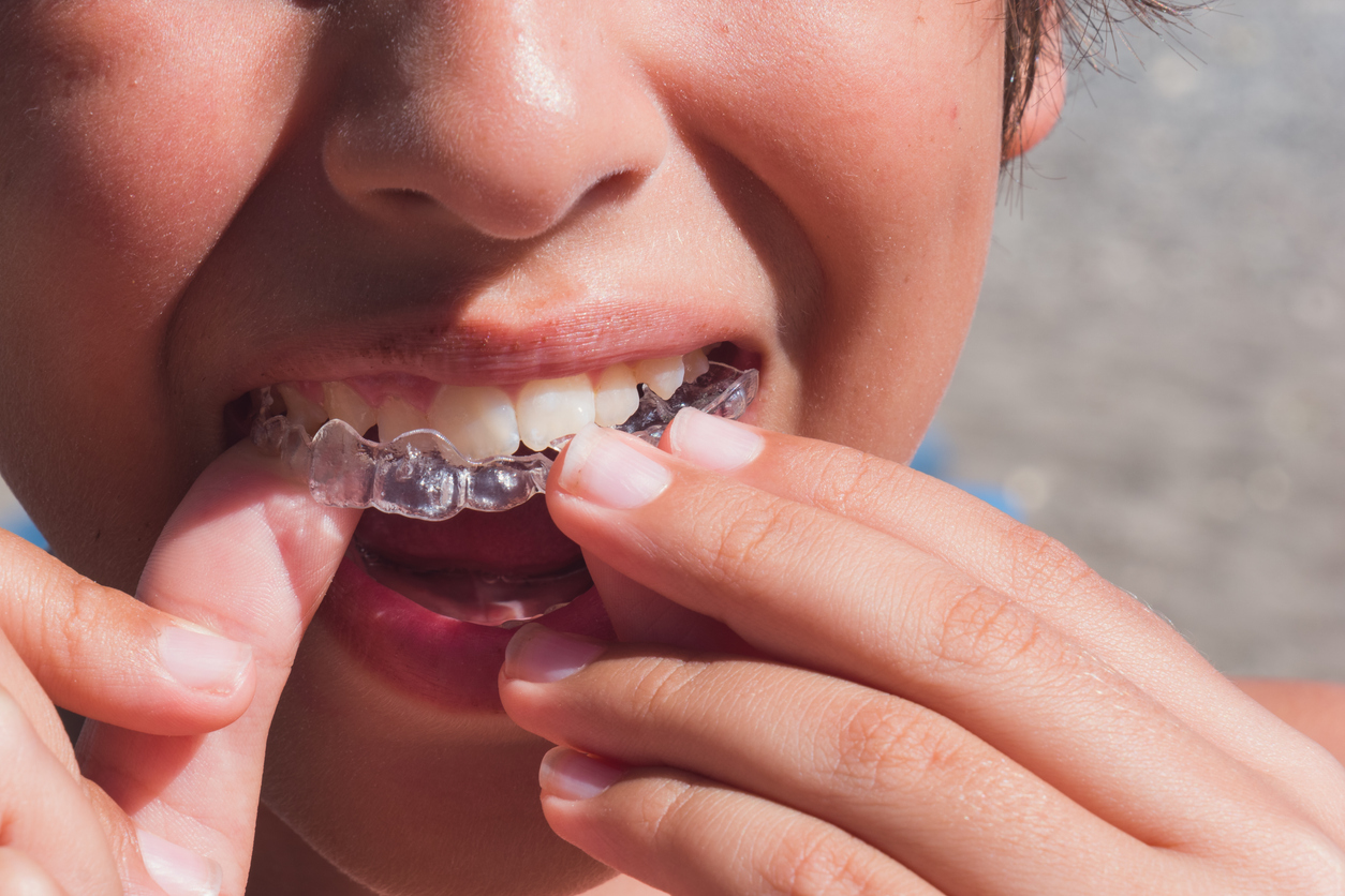 Invisalign Clear Aligners for Kids near Windsor, Wisconsin