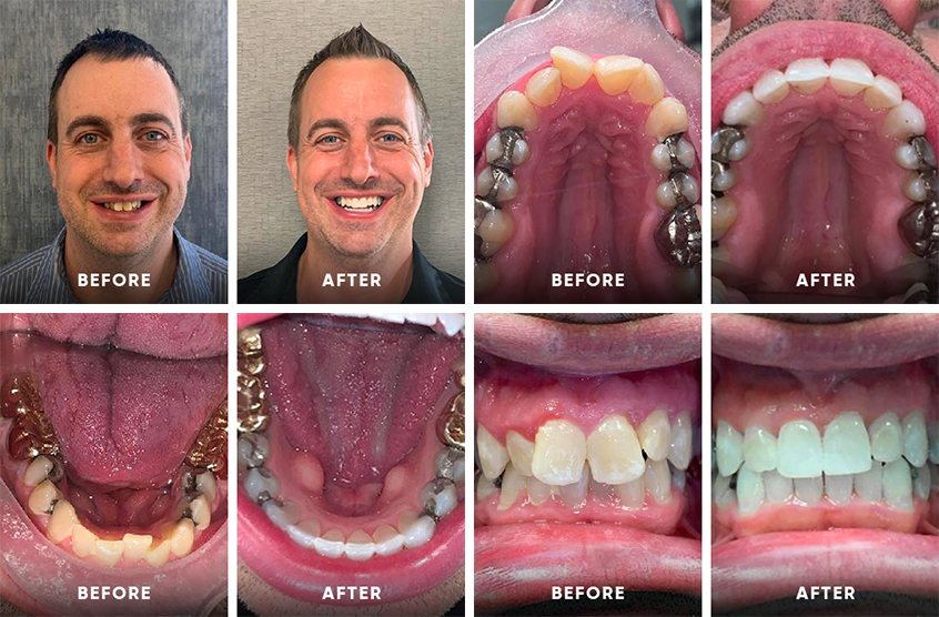 Invisalign® in Windsor, WI  Clear Braces for All Ages